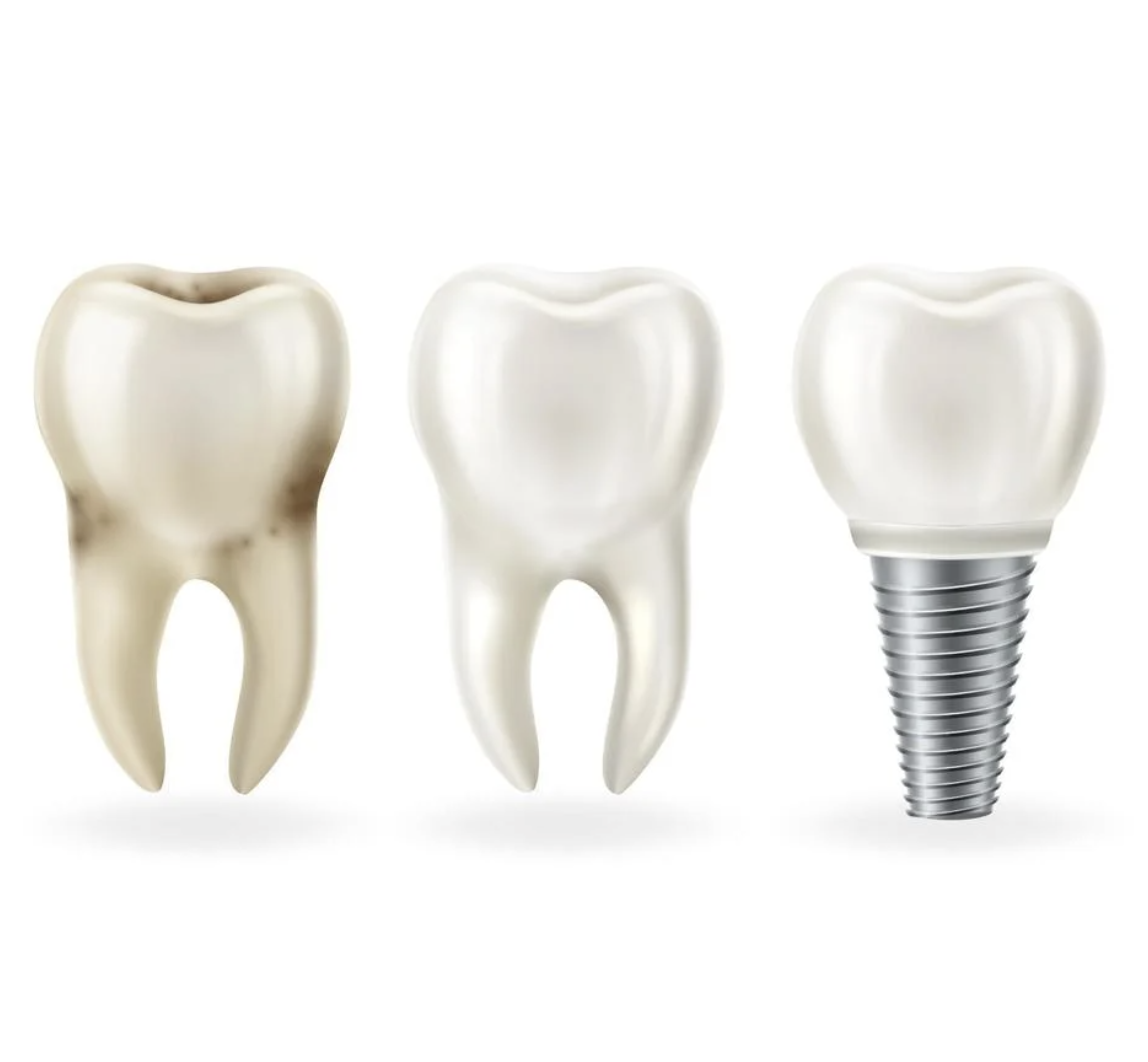 치아-임플란트-사진