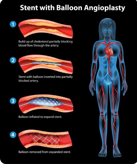 혈관 속 노폐물