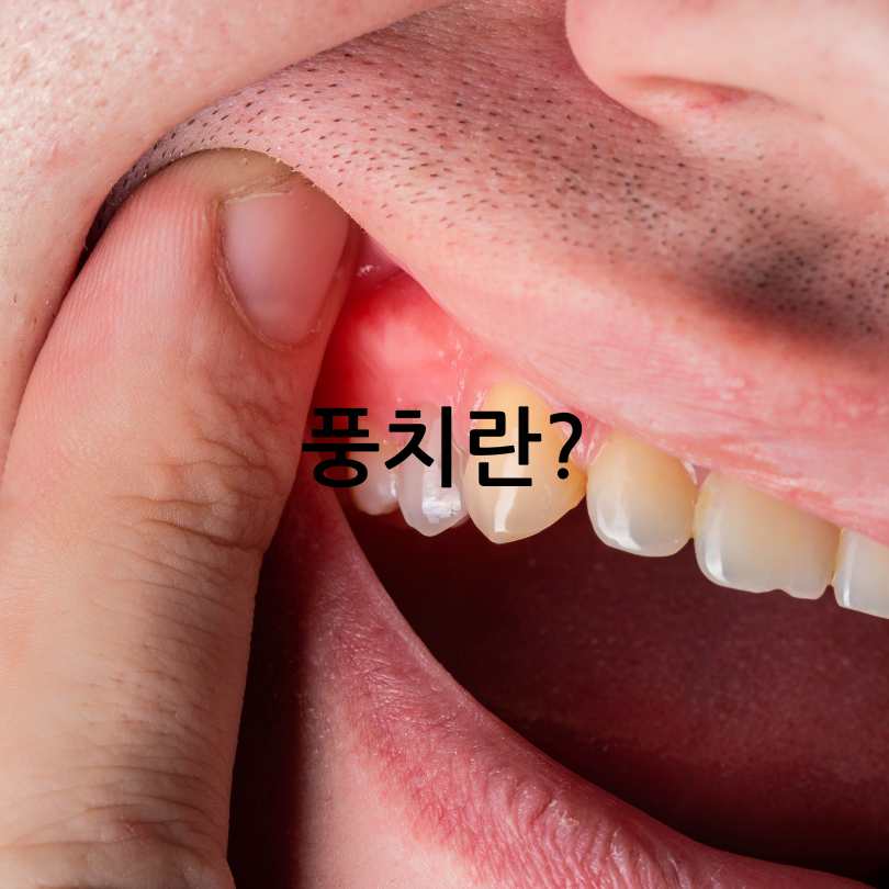 풍치 원인, 증상, 치료법부터 발치
