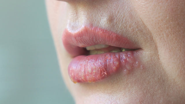 헤르페스 2형 1형 바이러스 치료법 증상 성병 연고 보균자