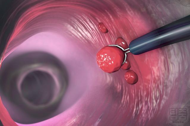 대장내시경 음식