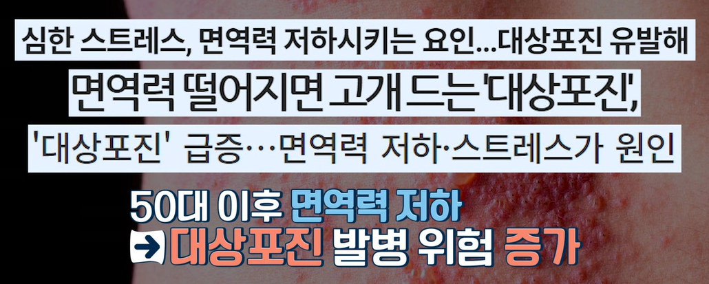 대상포진