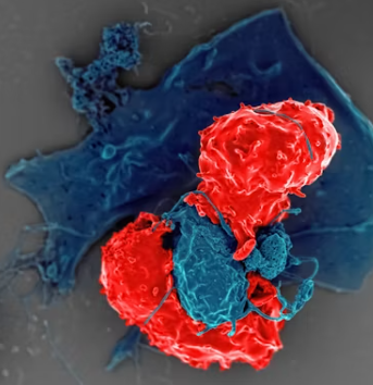 전립선 비대증 증상 치료 수술비용