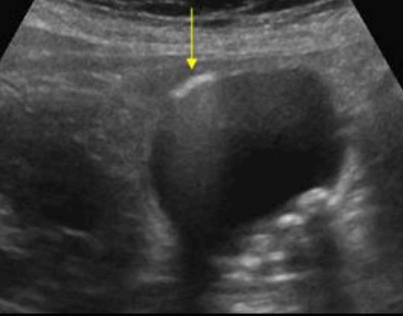 기종성 담낭염 (Emphysematous cholecystitis)