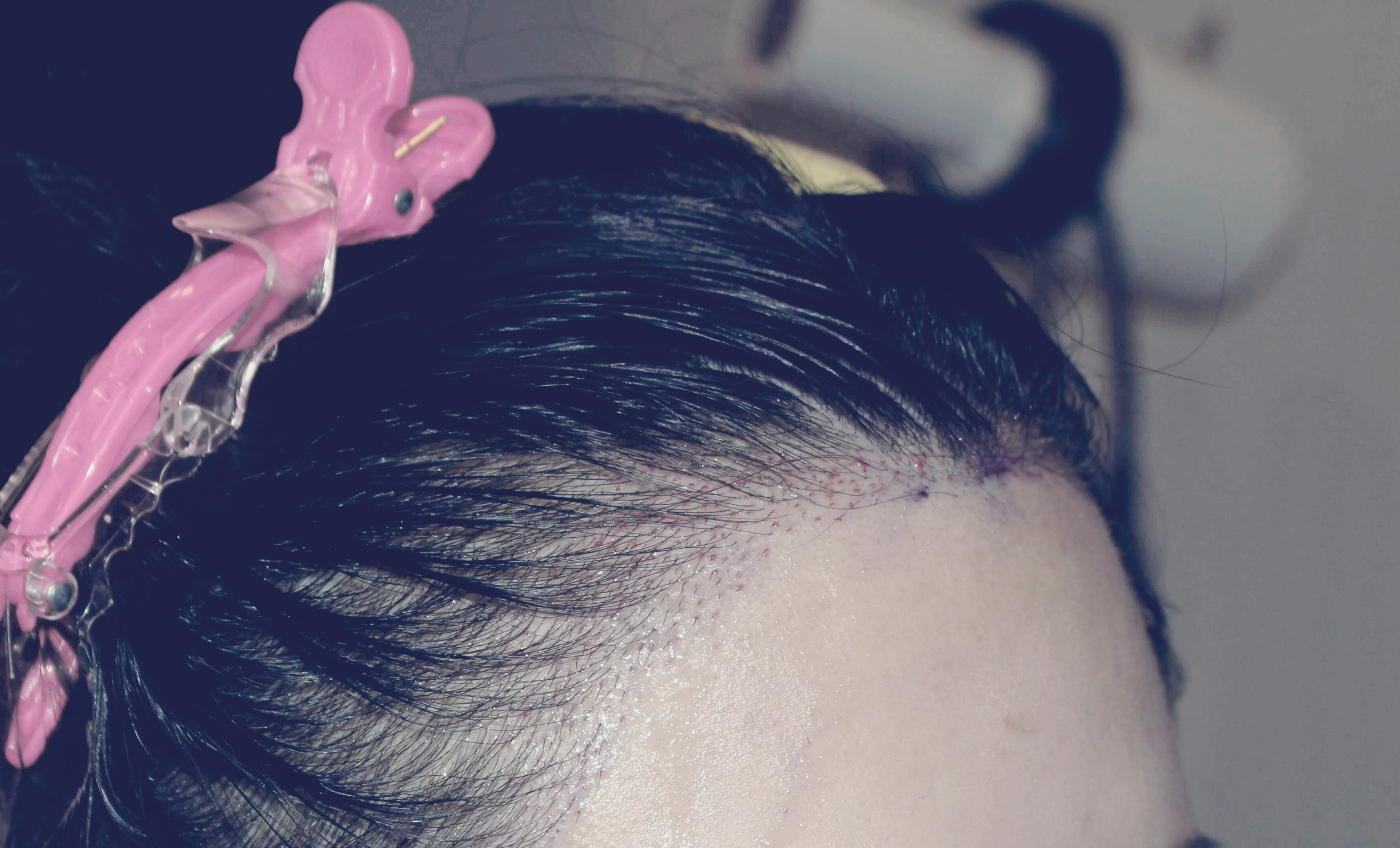 1차 보강 수술 후 우측