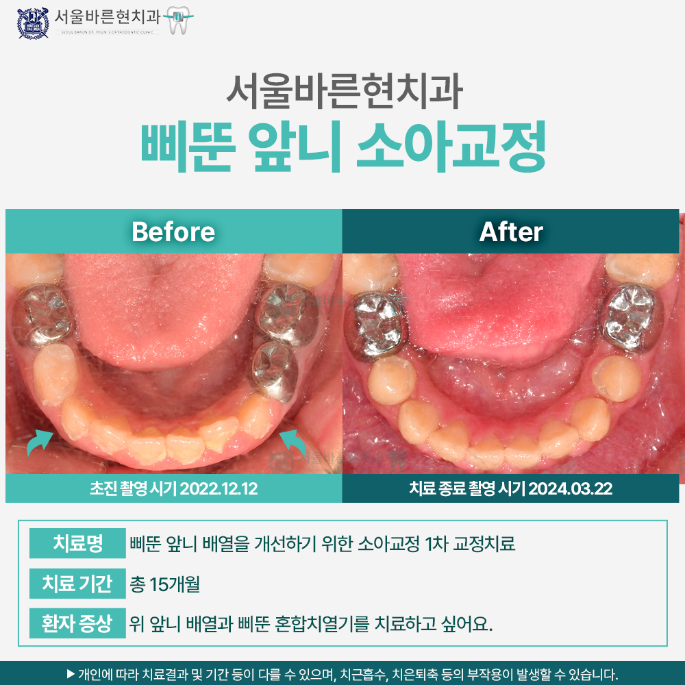 부산 소아교정