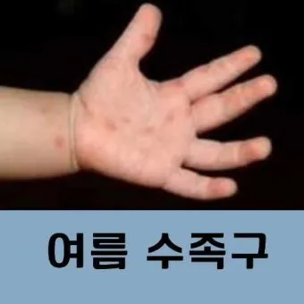 수족구 어른 전염에 대한 원인과 예방법 정리_20