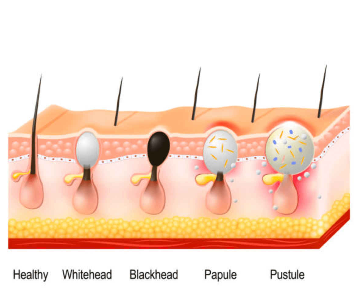 사타구니 종기 원인