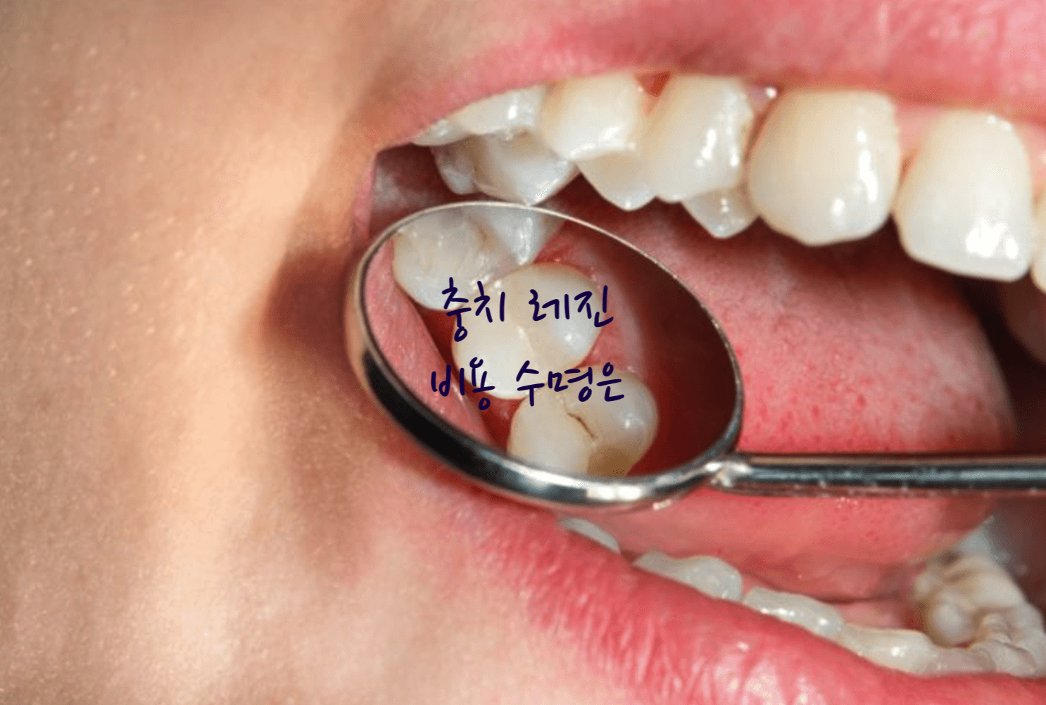 충치 레진 비용