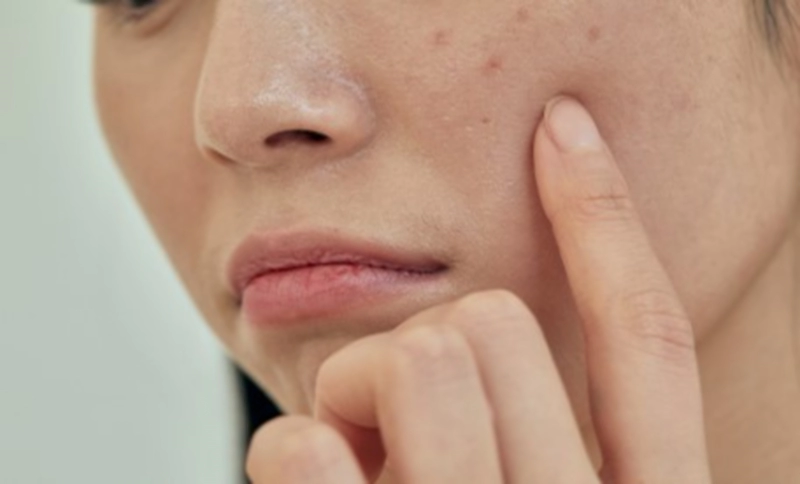 여드름 없애는법