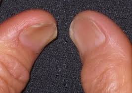 손톱과 빈혈의 관계