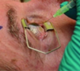 황반변성 자가진단&#44; 치료법&#44; 주사치료 가격