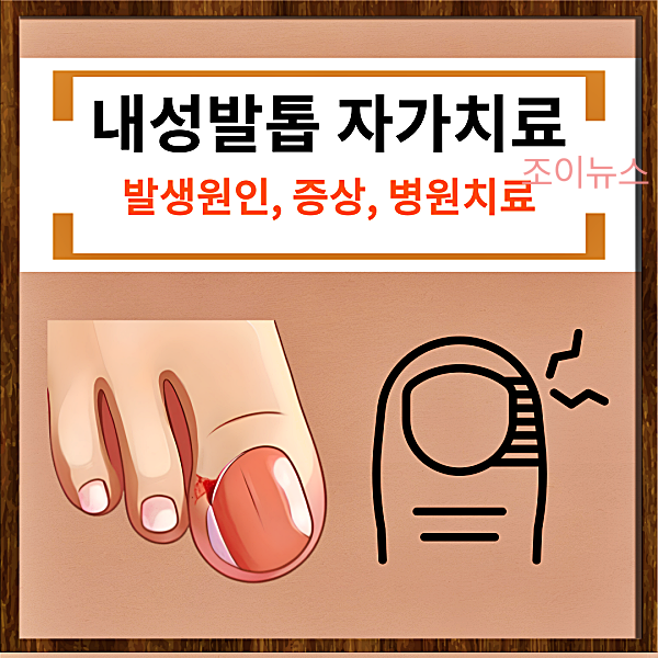 내성발톱 자가치료 방법, 이럴 땐 꼭 병원치료 받으세요!