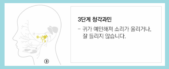 말초성 안면마비 신경손상 단계 이미지