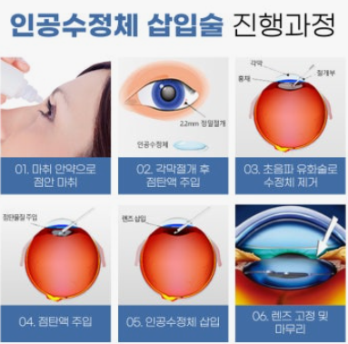 백내장 수술 발전과 인공수정체의 중요성 관련 이미지