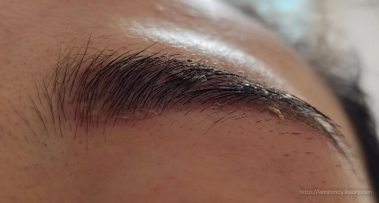 대구 눈썹문신 후 염증 딱지 발생