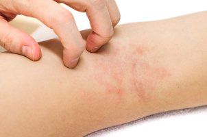 피부 발진 종류