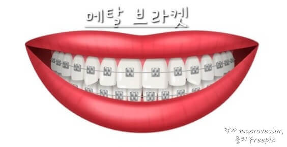 메탈브라켓