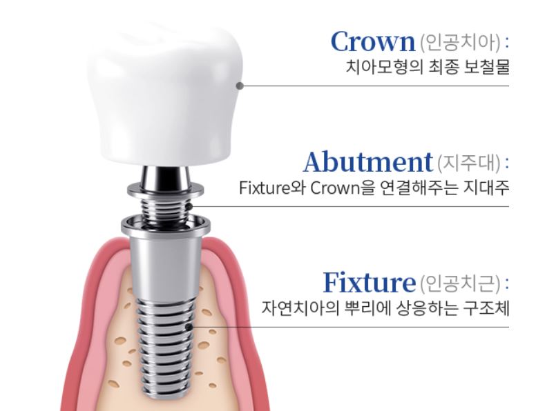 임플란트 구성