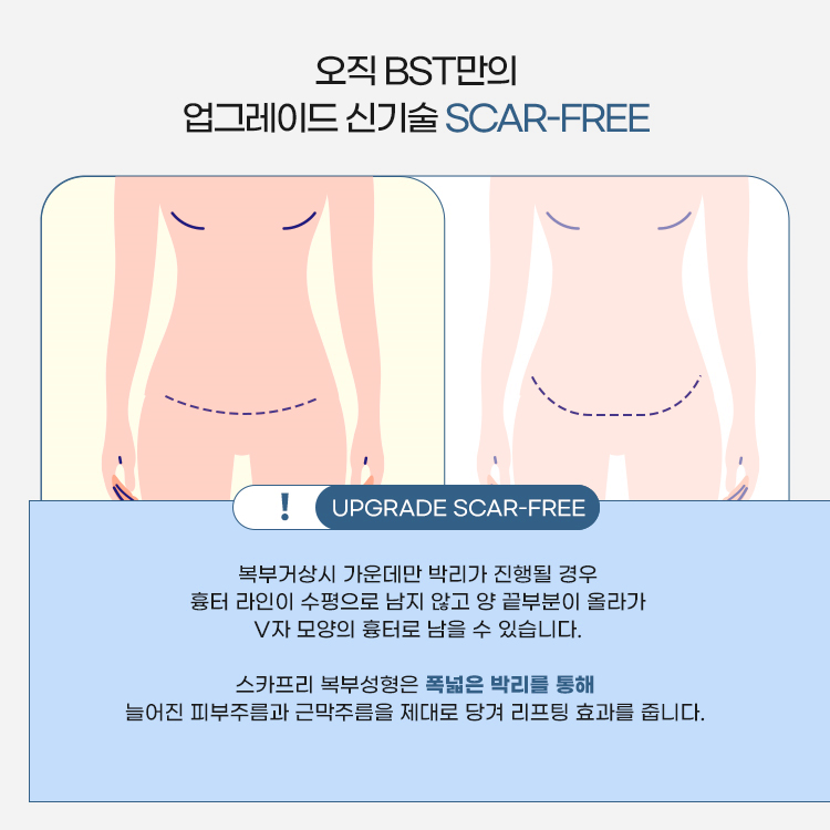 복부거상시 가운데만 박리가 진행될 경우 흉터 라인이 수평으로 남지 않고 양 끝부분이 올라가 V자 모양의 흉터로 남을 수 있습니다.