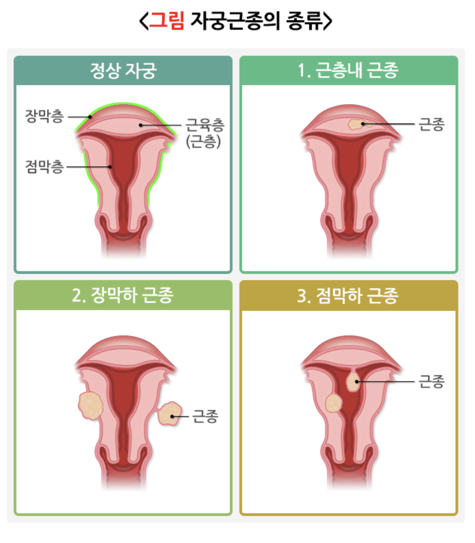 자궁근종의 종류