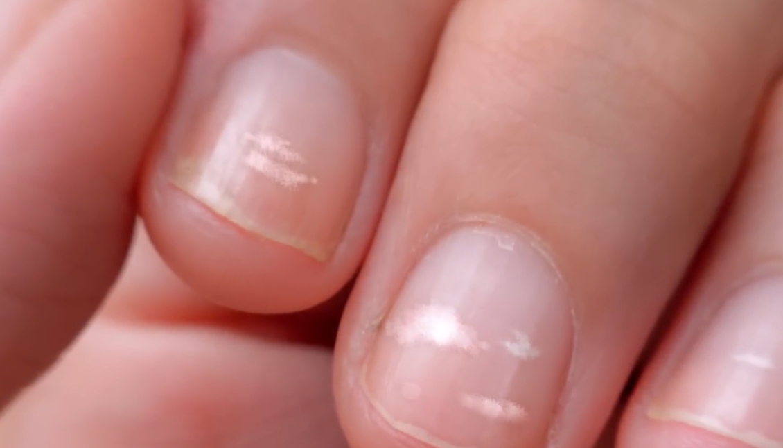 발톱이 검게 변하는 이유