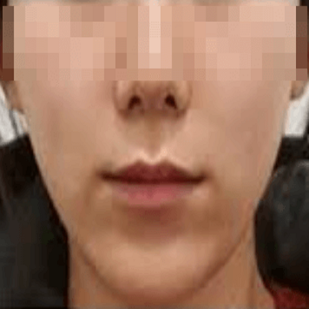 팔자주름 필러 맞고 난 후 사진