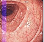 대장내시경 전 음식주의사항