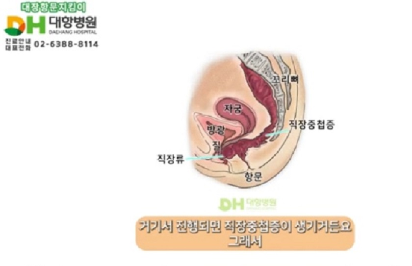 치핵명의