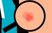 대상포진 증상 중 하나인 붉은 반점 증상을 나타낸 이미지입니다.