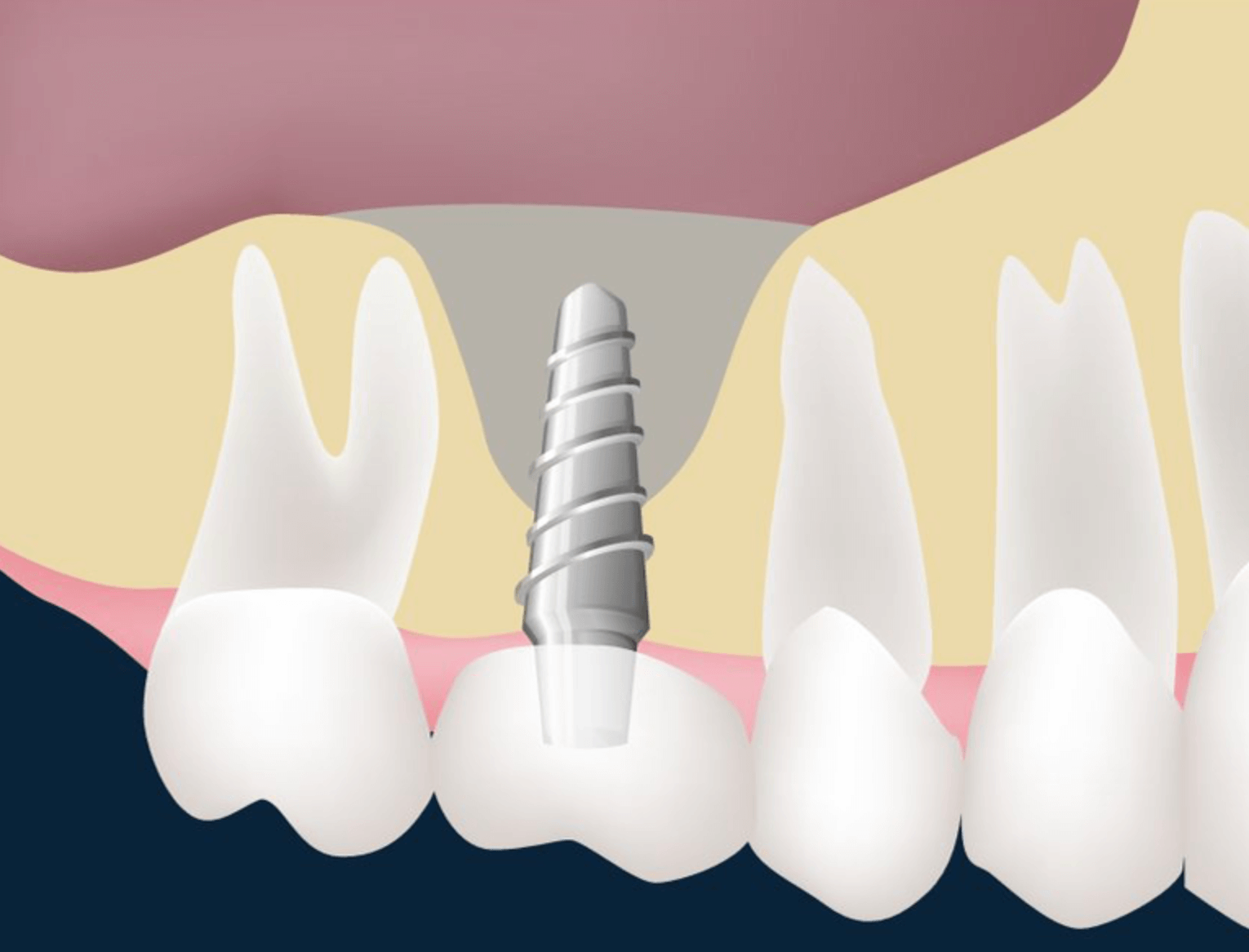 상악동-거상술-임플란트