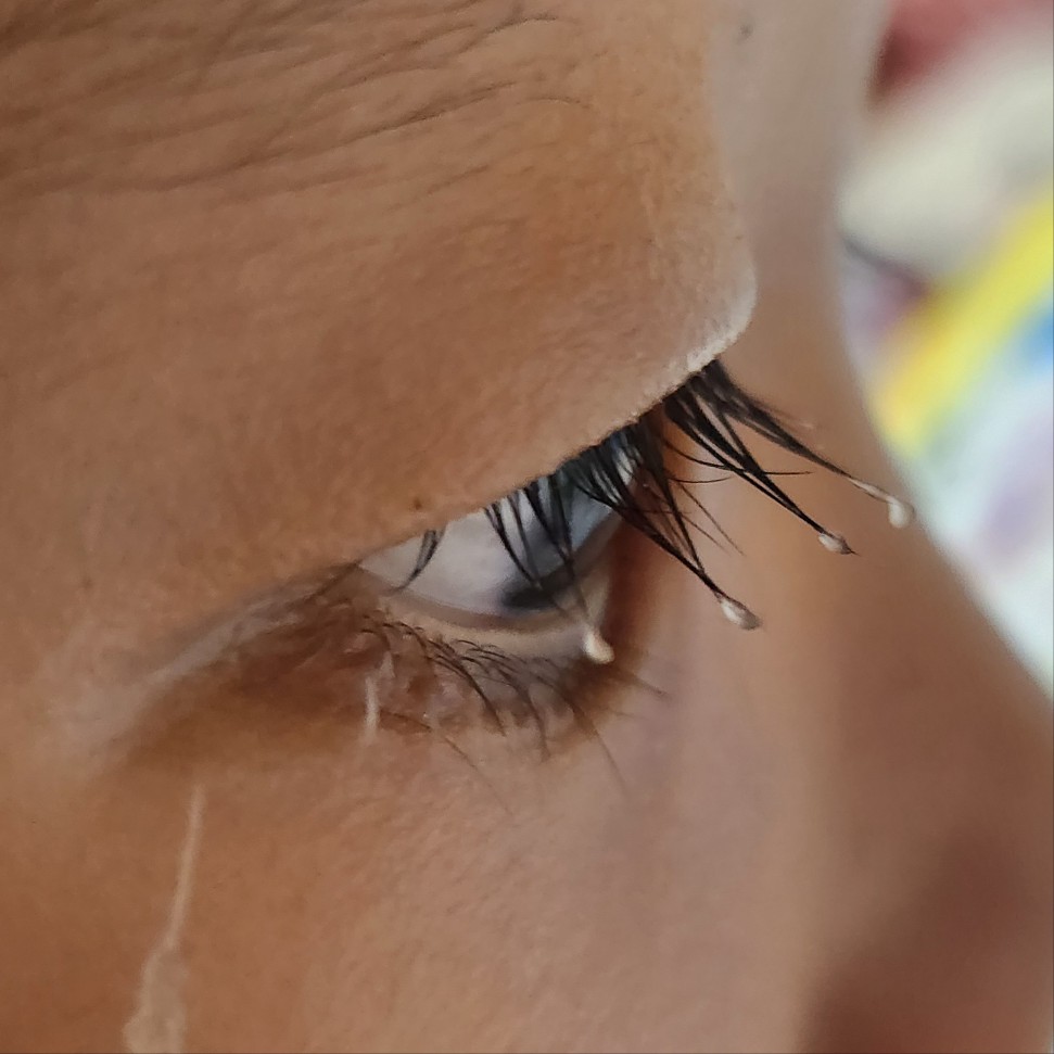 수술 8일 후 눈 옆모습