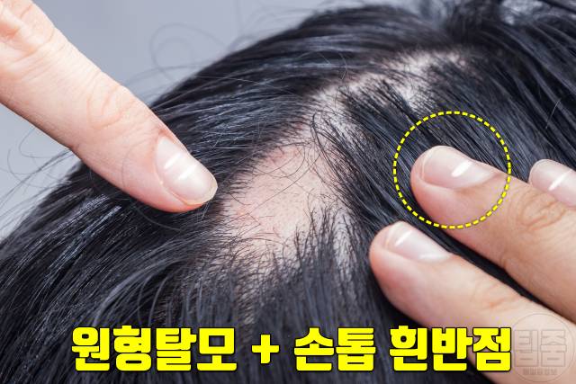 손톱 하얀 반점 손톱흰반점 손톱흰색가로줄 원인 원형탈모