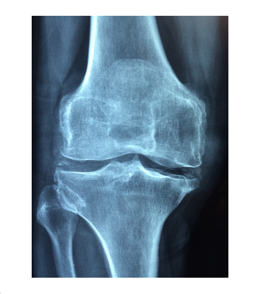 뼈에 관한 사진