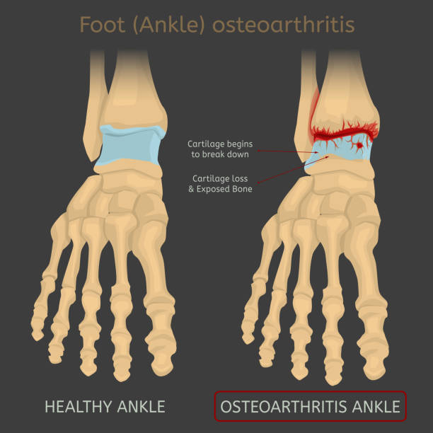 발목 관절염 증상 관절 걷기 치료 통증 수술 방법 초기 에 운동 유합술 고정술 인대 연골