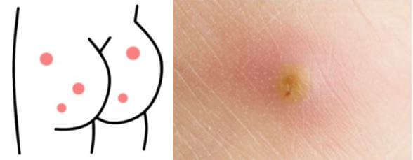 화농성 한선염 증상