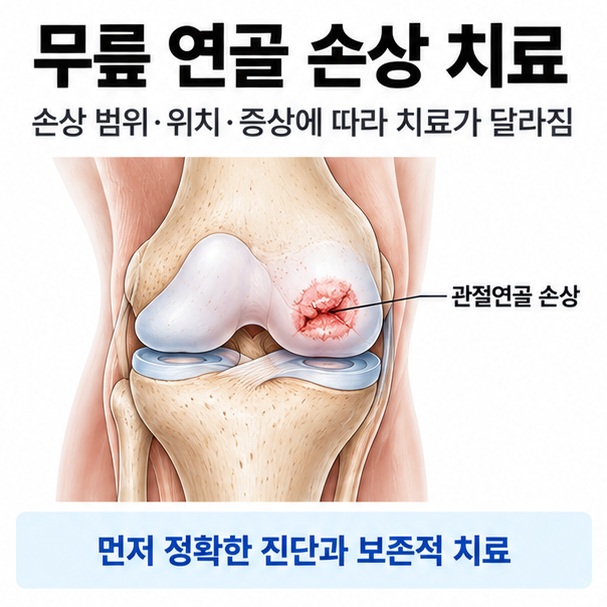 무릎 연골 손상 치료라는 제목과 무릎 관절연골의 손상 부위, 냉찜질과 재활운동을 함께 표현한 대표 이미지