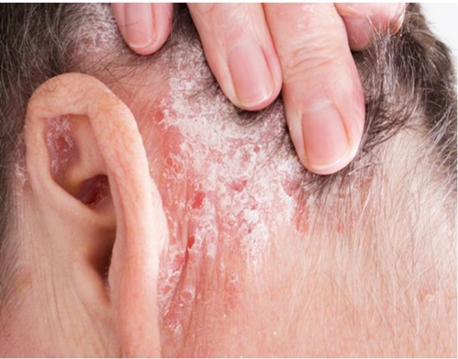 건선 초기 증상