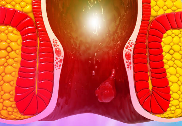 엉덩이 종기 원인과 관리하는 방법&amp;#44; 종기는 누구나 한 번쯤은 겪을 수 있는 흔한 질환이지만&amp;#44; 안일하다고 생각해서 치료를 하지 않는다면 삶의 질이 떨어질 수 있습니다. 특히 엉덩이 종기는 일상생활에 지장을 줄 수 있어 엉덩이 종기의 원인을 파악하고 병변에 맞는 치료를 진행하는 것이 매우 중요합니다. 참고해주세요.