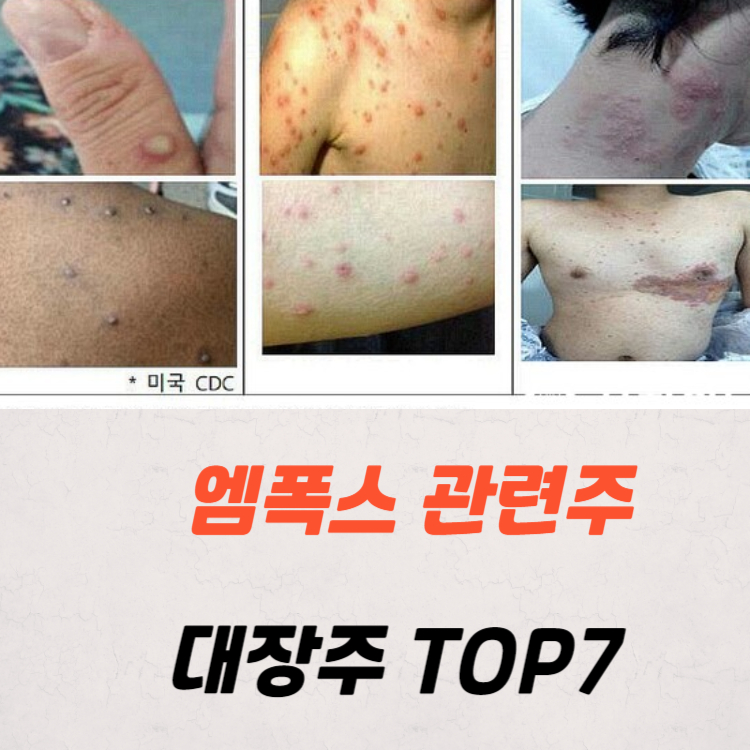 원숭이두창 엠폭스 관련주 대장주 테마주 TOP7