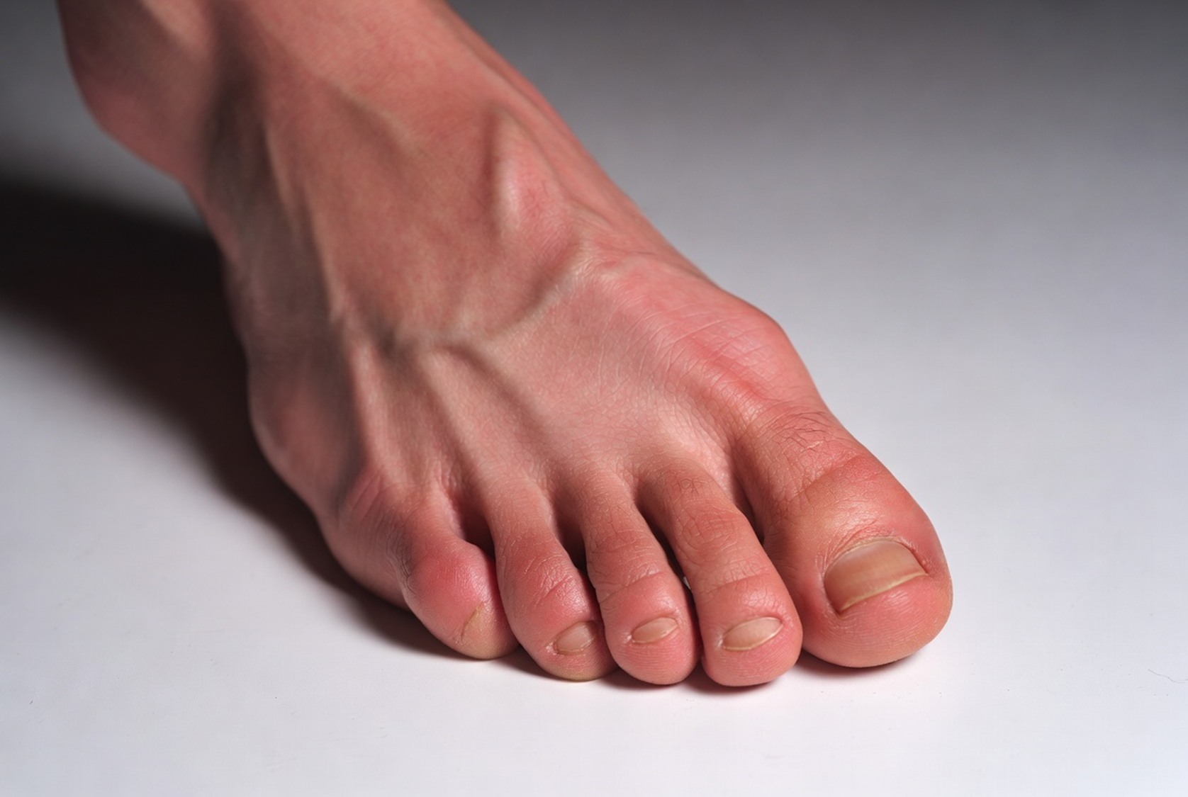 발바닥통증 지간신경종 중족통 발건강관리 발아치교정