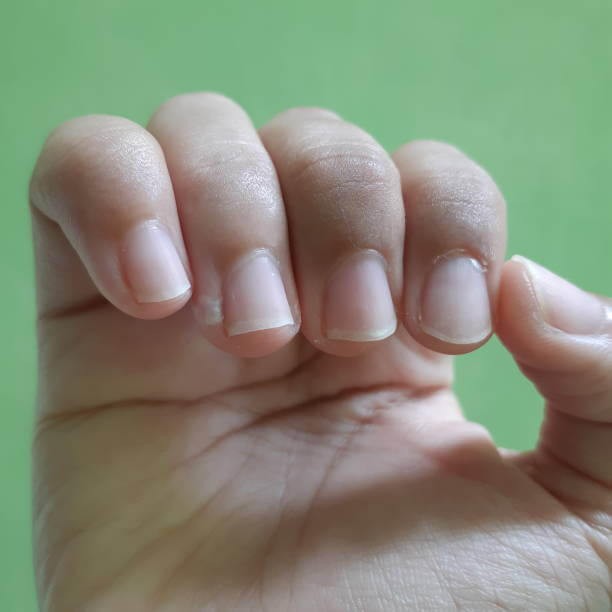 조갑주위염, 손톱염증을 일으키는 거스러미를 아시나요? 나도 모르게 항상 입으로 손을 뜯고 있는 나를 발견하는데요. 절대로 하지 말아야 할 행동입니다. 아무 생각없이 뜯고 있으면 피까지 나올 때가 있습니다. 왜 생기고 어떻게 예방을 해야 하는 걸까요?