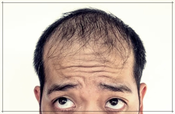 견인성 탈모와 그 원인&amp;#44; 대처 방법.