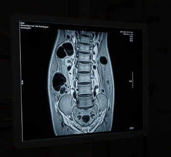 척추 협착증 초기 증상 및 원인9