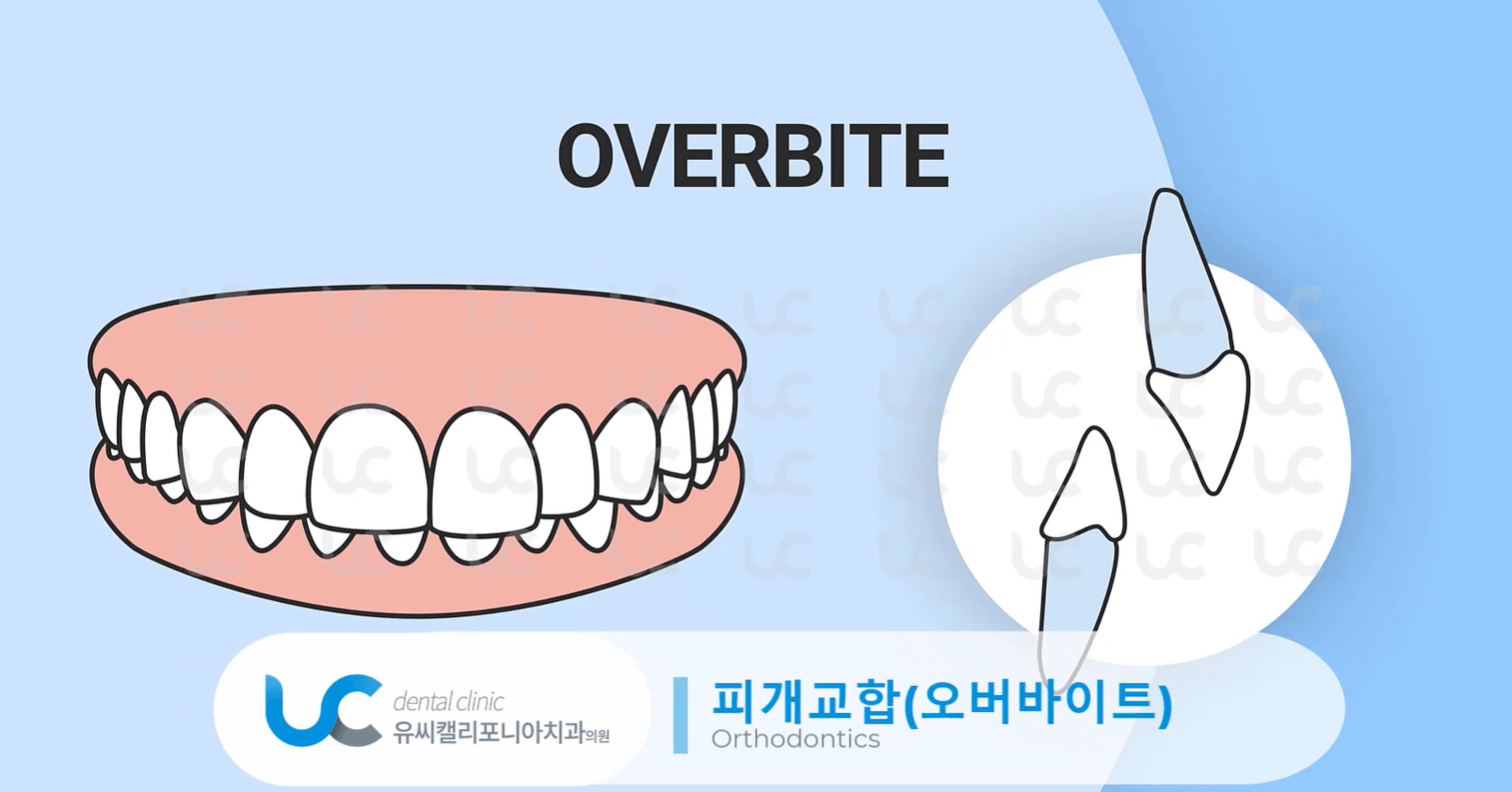 과개교합-치료-안하면