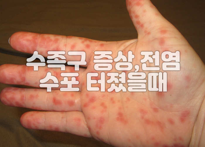 수족구로 인해 아이 손에 발진이 가득히 돋아나 있다
