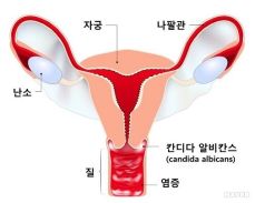여성 질환: 질염- 종류와 특징, 증상, 예방 방법, 치료 방법.