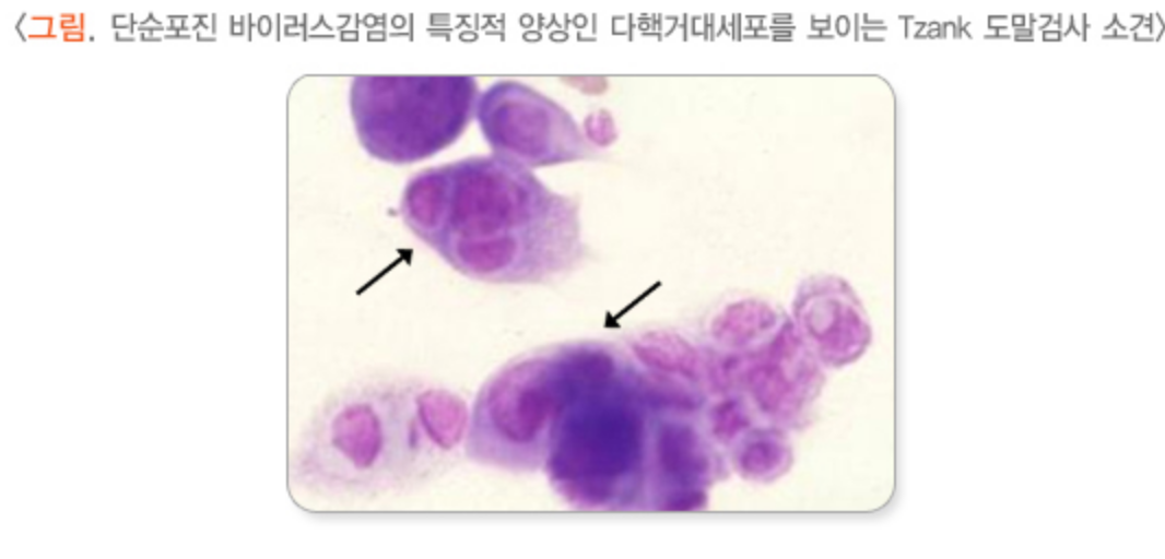 단순포진바이러스