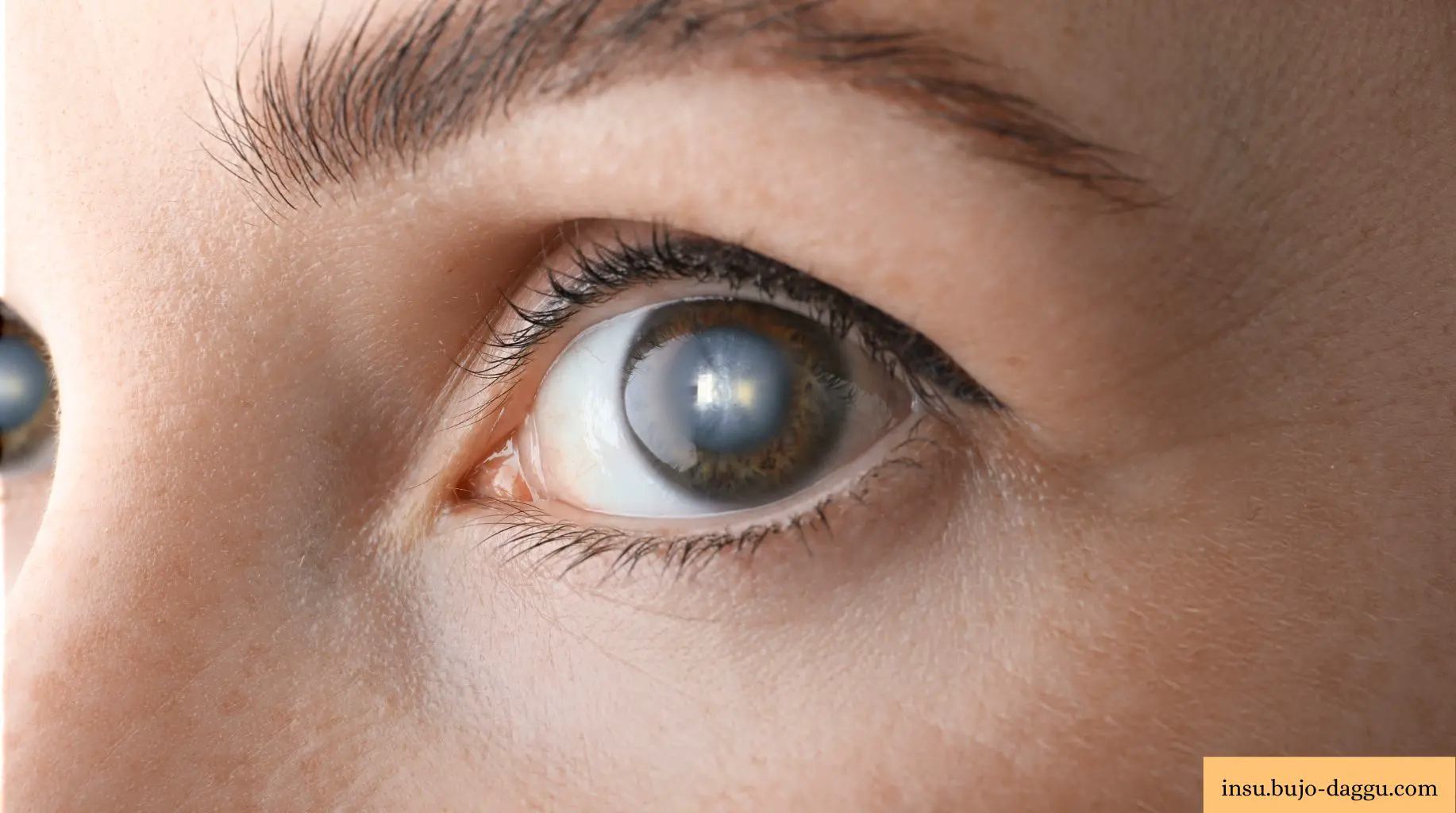 백내장 수술 실비 청구 서류 총정리｜진단서&middot;약제비&middot;다초점 렌즈까지 한 번에