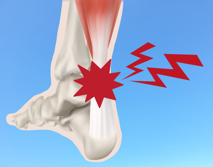 아킬레스건 통증